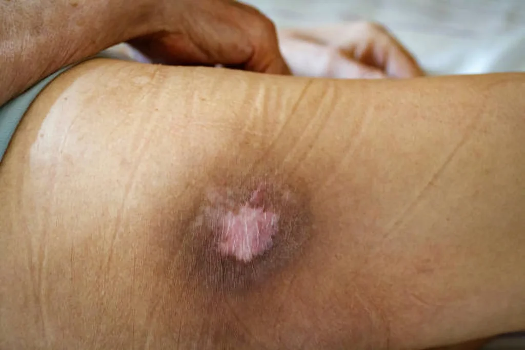 Image of a bed sore almost healed